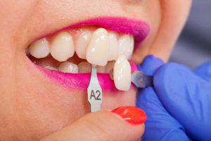 Dental Veneers Phoenix AZ Dental Shade Determination
